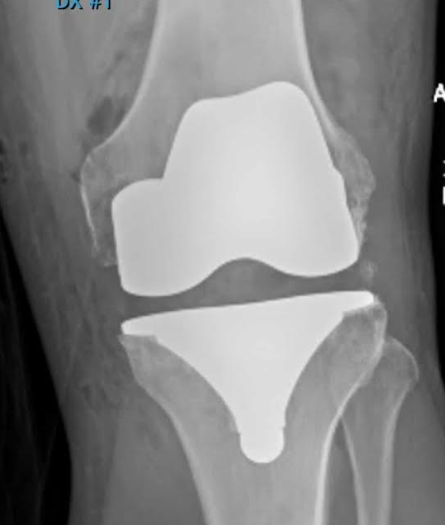 my new knee.png