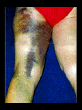 hamstring.gif